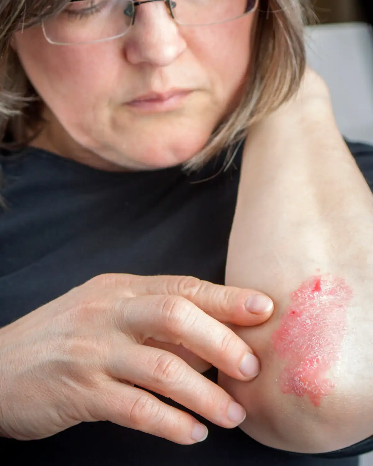 A woman with a patch of red on her arm.