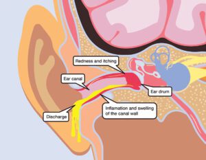 Swimmer's Ear Diagram